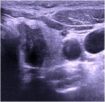 Case report: Ultrasound misdiagnoses atypical parathyroid adenoma as malignant thyroid tumor